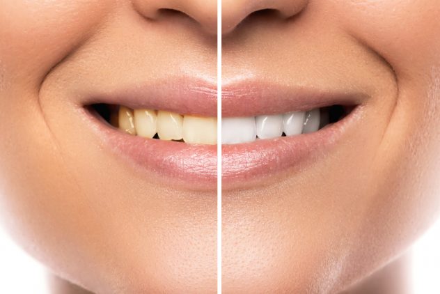 Comparison after teeth whitening