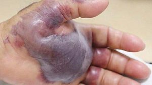 Mies söi tavalliseen tapaan sushia – myöhemmin lääkärit joutuivat amputoimaan hänen kätensä Vibriosis2