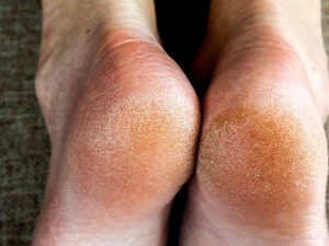 kuivat jalat-kovettumat